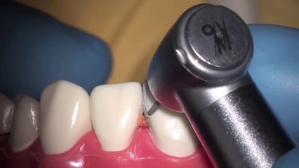 Установка виниров