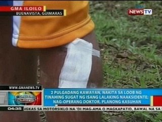 BP: 2 pulgadang kawayan, nakita sa loob ng tinahing sugat ng isang lalaking naaksidente