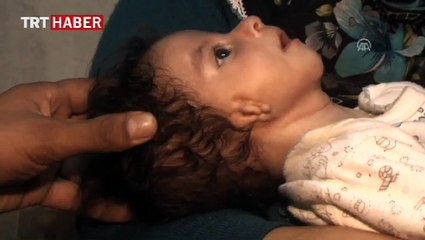 Kulak delikleri kapalı doğan bebeklerinin tedavisi için yardım bekliyorlar