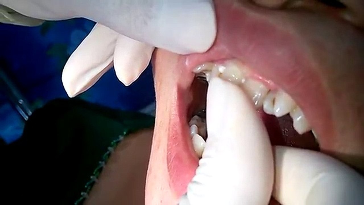 Nhakhoamedita.vn | Cận cảnh quá trình bọc răng sứ Zirconia