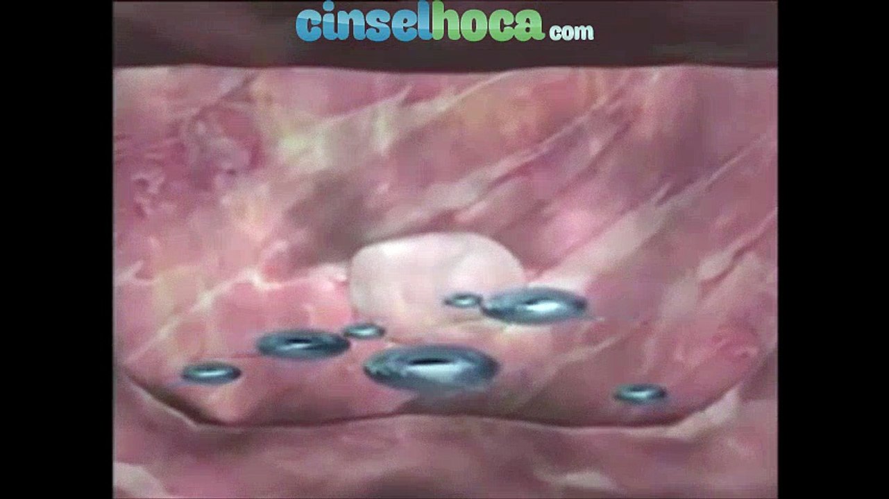 Kürtaj, Kürtaj Nedir Nasıl Yapılır, Kürtaj Fiyatları, Kürtaj Sonrası, Gebelik Sonlandırma | www.cinselhoca.com