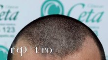 CLINICAS CETA CAPITAL www.injertodepelo.es