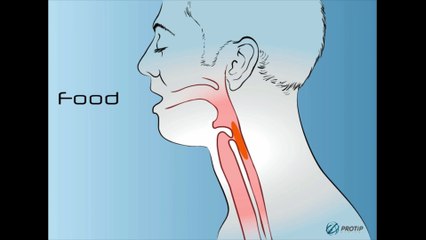 Implantation d’un larynx artificiel