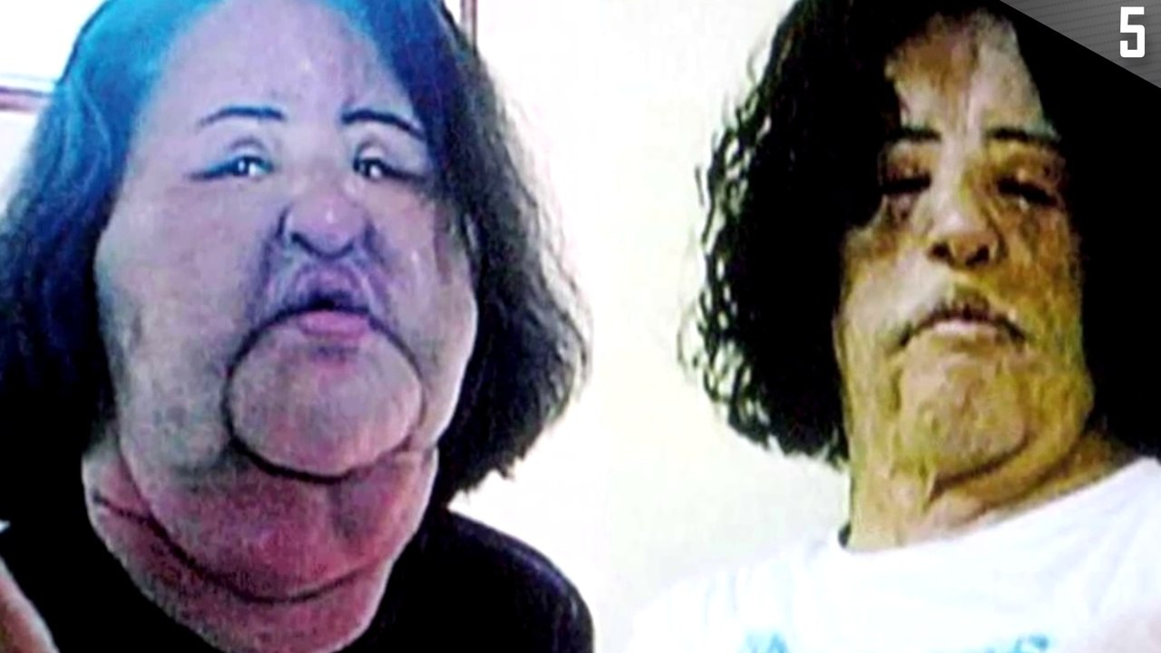 10 Worst Botched Plastic Surgeries