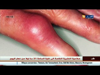 3 دقائق صحة تورمات الأصابع ..ما هي و ما أسبابها!!