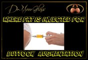 Where is the fat injected for buttock augmentation
