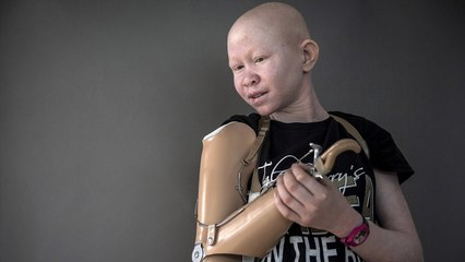 Tanzania's 'ghost people': Putting an end to albino persecution