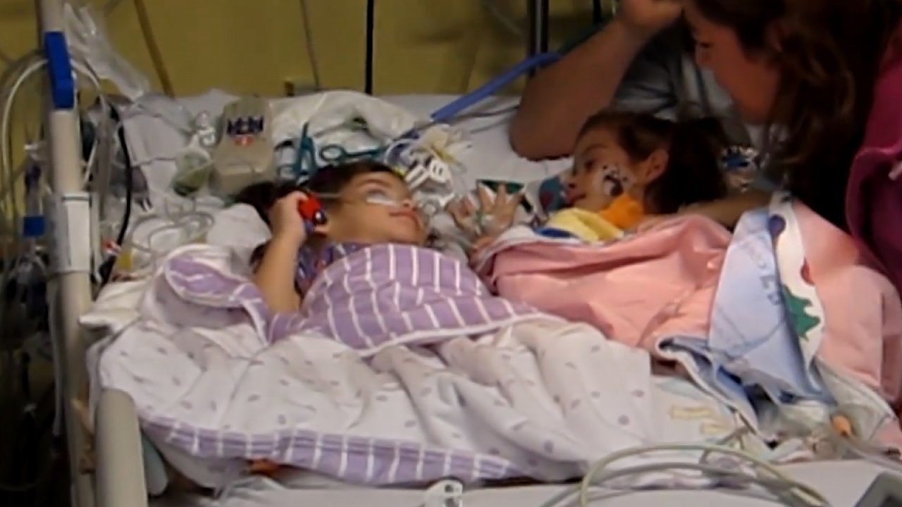 Formerly conjoined twins reunited for the first time