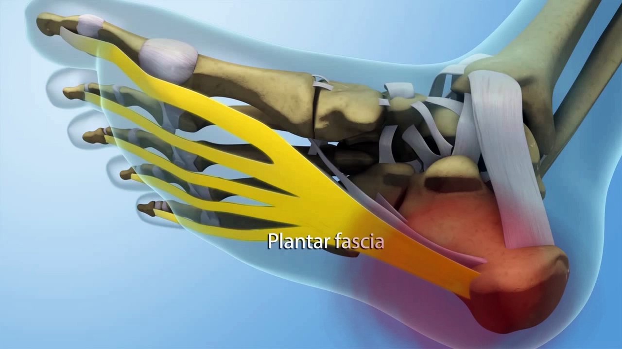 Treating of Plantar Fasciitis