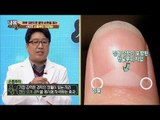 하루 5분 ‘손톱뿌리 지압법’으로 혈액 순환을! [내 몸 사용설명서] 130회 20161125