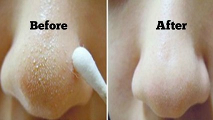 How to Get Rid of Blackheads & Whiteheads At Home in 7 Days