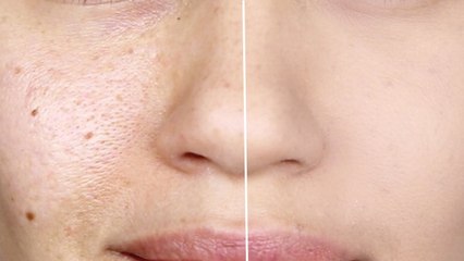 How to make Pores Disappear - How to make Large Pores Vanish