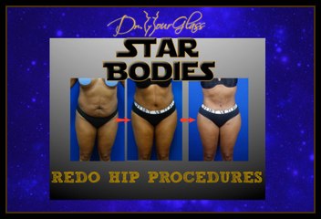 Redo hip augmentation