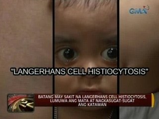 Batang may sakit na Langerhans Cell Histiocytosis, lumuwa ang mata at nagkasugat-sugat ang katawan