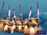 Spinal Fusion for Scoliosis Correction Animated Video | SurgeryLog