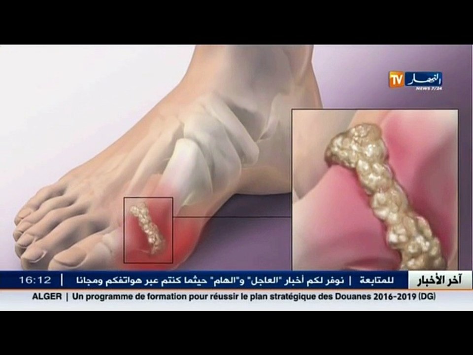 3 دقائق صحة   هذا ما قد يسببه أكل اللحوم و البروتينات بكثرة........ آلام المفاصل