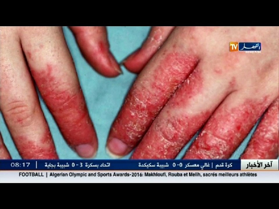 "دقائق صحة "مرض الاكزيما3