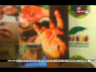 SONA:  Binatilyo, naputulan ng kamay matapos maputukan ng inipong pulbura