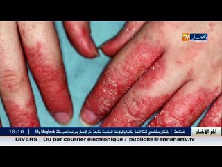 3 دقائق صحة   الإكزيما .... أشكالها ... مسبباتها و كيفية الوقاية منها
