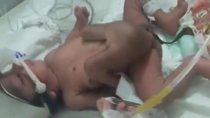 Un bébé nait avec 4 jambes et 2 pénis