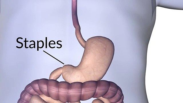 Лечение рака пищевода в Израиле