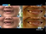 Say goodbye to incomplete smile with dentures | Pinoy MD