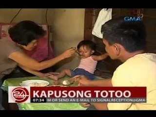Bukol sa mukha ni Amy, posibleng dulot ng kakulangan sa Folic Acid ng kanyang ina noong nagbubuntis
