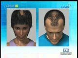 The difference between men's and women's hair loss | Pinoy MD