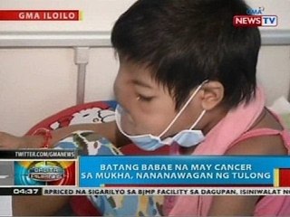 Batang babae sa Iloilo City na may cancer sa mukha, nananawagan ng tulong