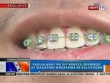 NTG: Paglalagay ng DIY braces, delikado at maaring makasama sa kalusugan