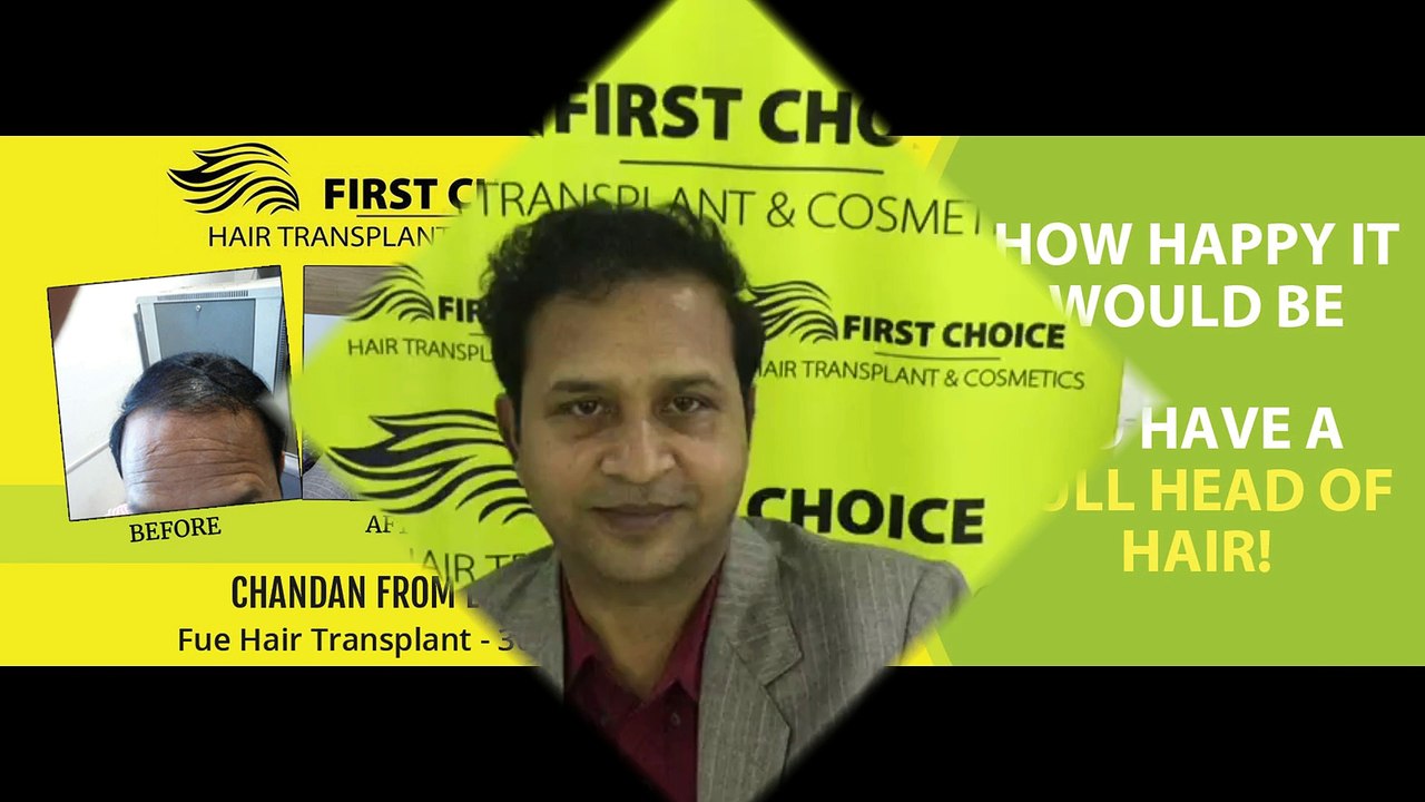 Hair Transplant in Ludhiana- patient's results after 10 months of his surgery