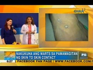 How to get rid of warts