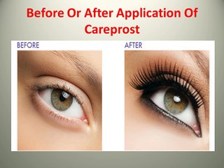 See The Variance In Growth Of Eyelashes With Regular Usage Of Careprost Eye Drop