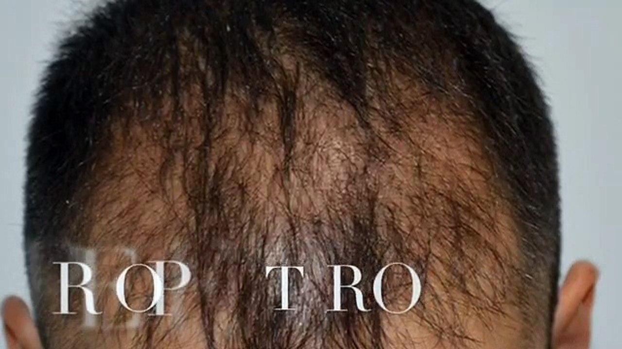 CLINICAS CETA CAPITAL www.injertodepelo.es