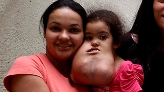 Une enfant de 3 ans se fait opérer sa tumeur au visage