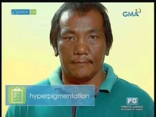 Dark spots in skin may be a sign of serious medical conditions | Pinoy MD