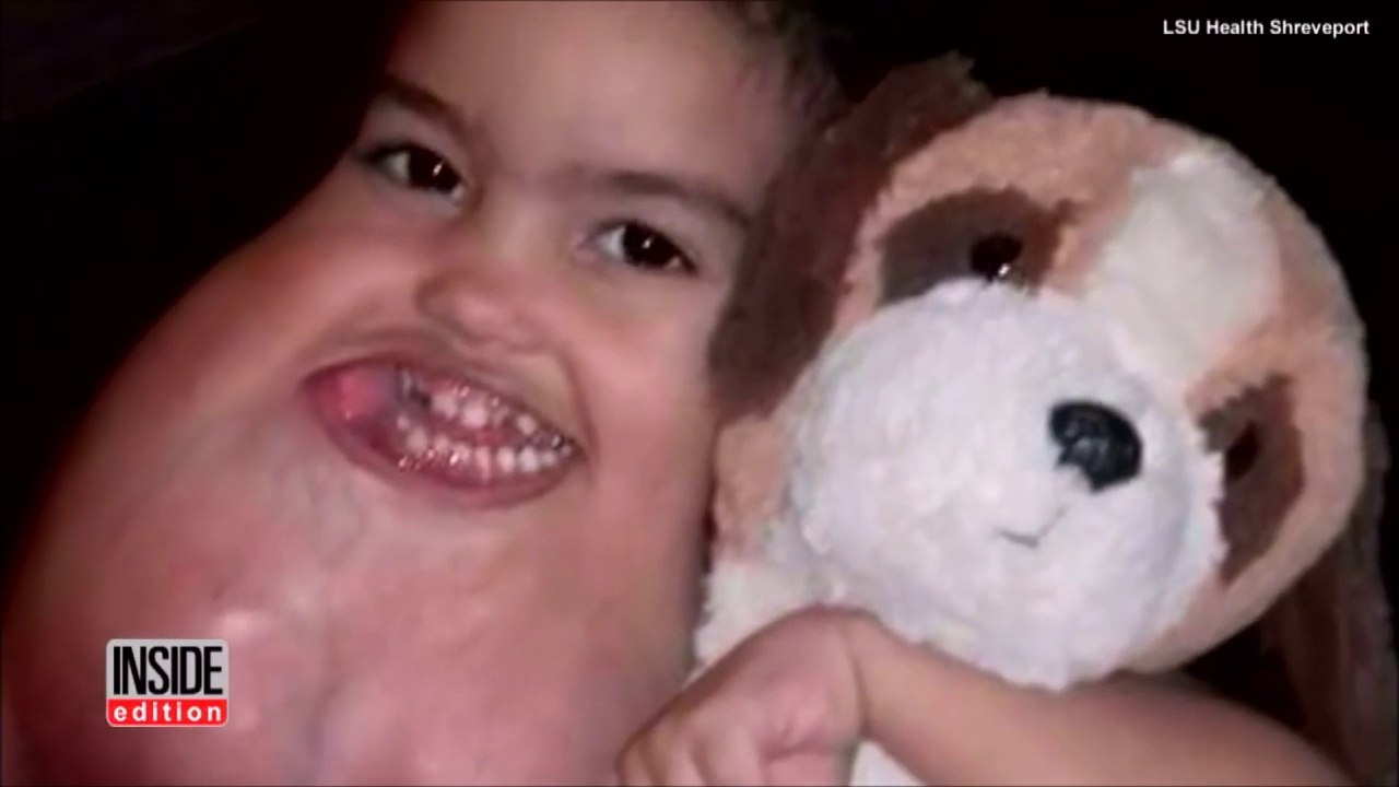 Cet enfant de 3 ans se fait opérer d'une tumeur au visage énorme!