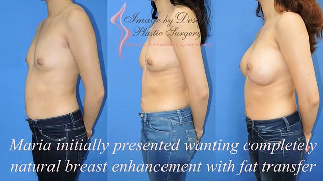 Natural Breast Augmentation in St Clair Shores Michigan