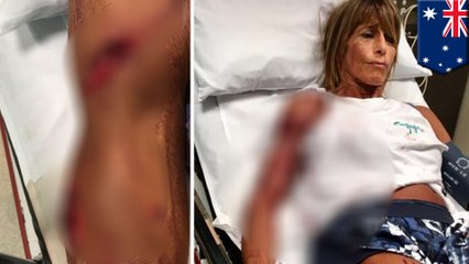 【閲覧注意】カンガルーにボコボコにされた女性　35針縫う大けが