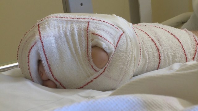 Trasplantan dedos de los pies a la mano de un paciente