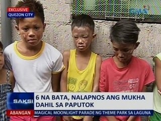 Saksi: 6 na bata, nalapnos ang mukha dahil sa paputok