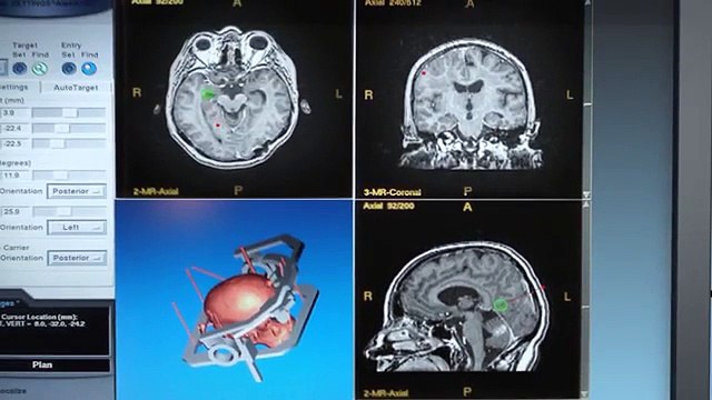Опухоль головного мозга и лечение рака мозга в Израиле