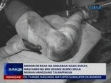SAKSI: Menor de edad na sinilaban ng buhay, nagtamo ng 3rd degree burns