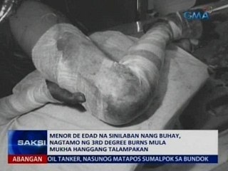 SAKSI: Menor de edad na sinilaban ng buhay, nagtamo ng 3rd degree burns