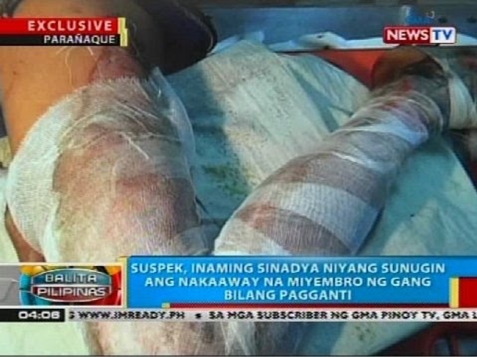 12-anyos na lalaki, nalapnos ang balat matapos umanong sunugin ng nakaaway na miyembro ng gang