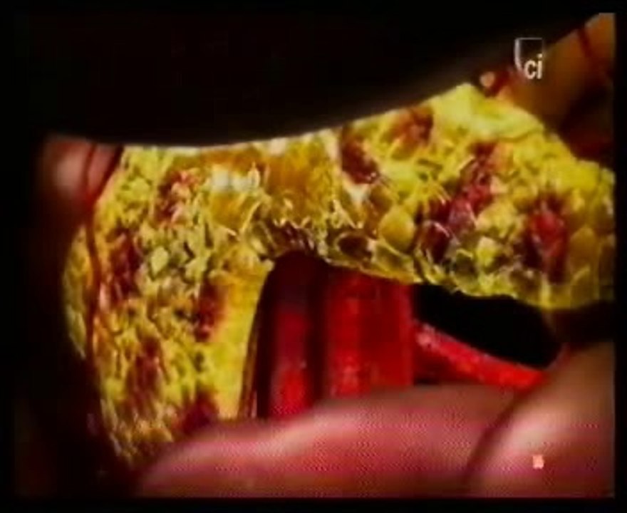 Pancreatitis por alcoholismo: Autopsia forense