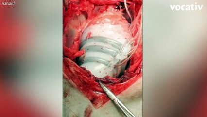 A Robot That Makes A Weak Heart Strong