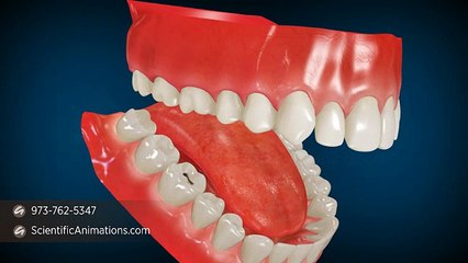 Dental Air Abrasion - 3D Dental Animations