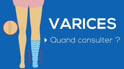 Varices : quand consulter ?
