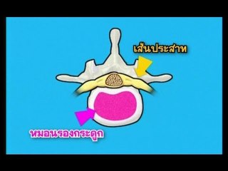 ชิดหมอ ..( Ep.25 ).. ตอน "หมอนรองกระดูกทับเส้นประสาท"